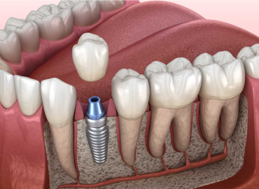 Single Dental Implant